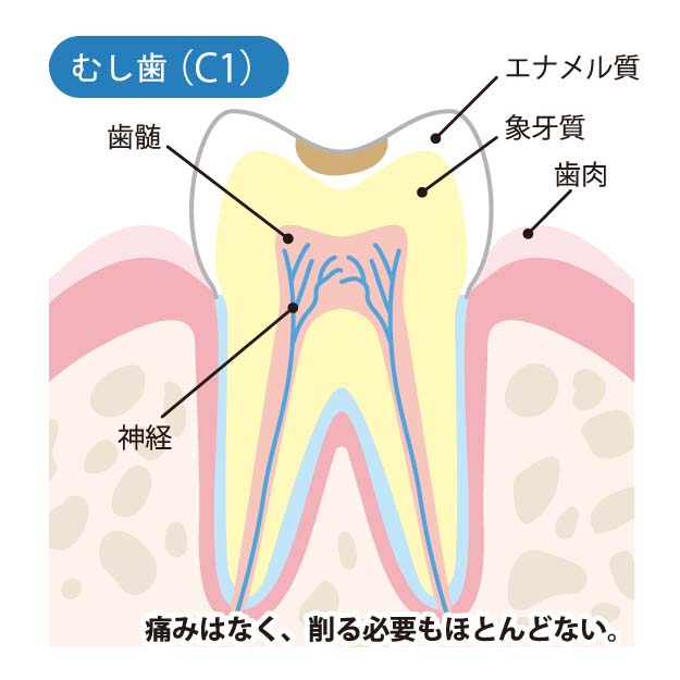 【C1】エナメル質のむし歯
