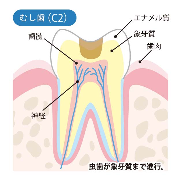 【C2】象牙質（ぞうげしつ）のむし歯