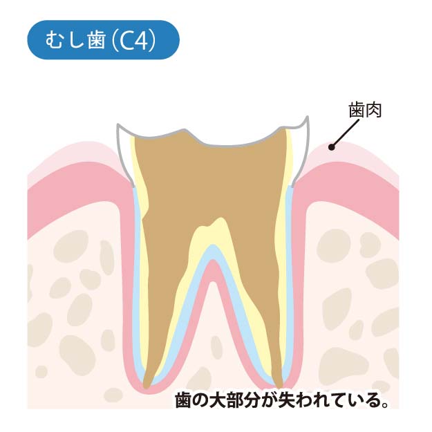 【C4】末期のむし歯