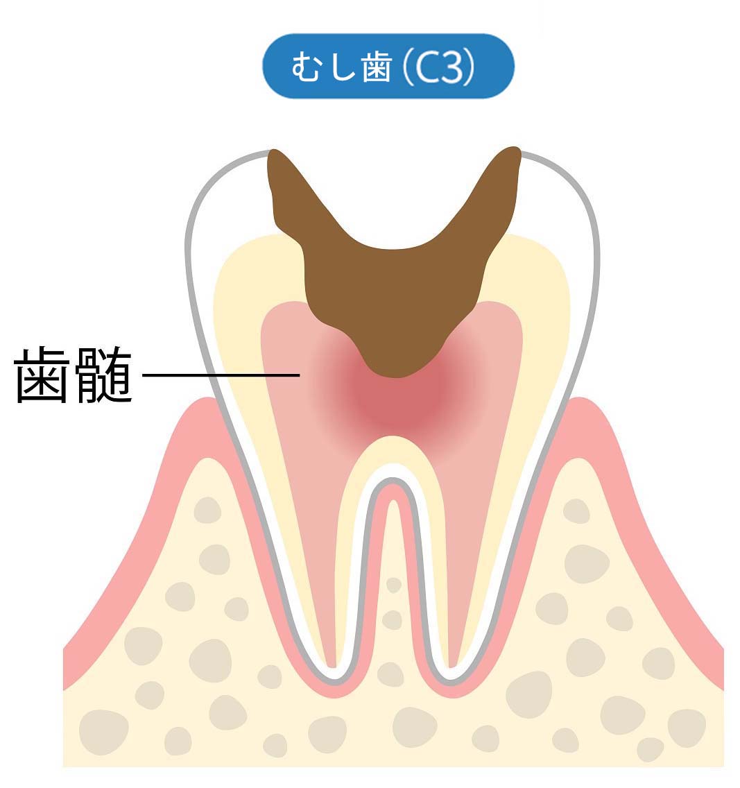 【C3】歯髄（しずい）に達したむし歯